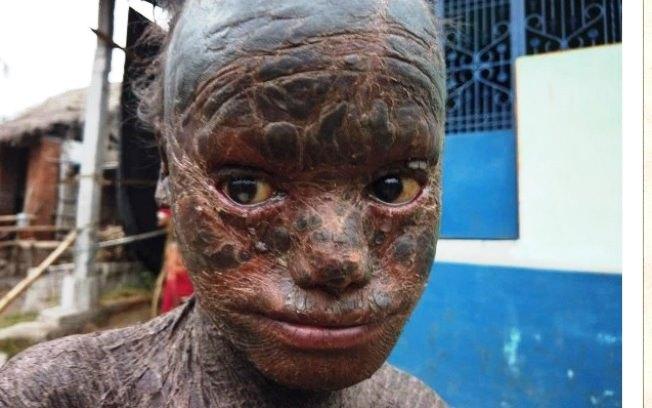 Menino de 10 anos sofre de condição rara que o deixa com “pele de cobra”