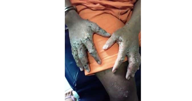 Detentos são ‘comidos vivos’ por bactéria desconhecida em Roraima