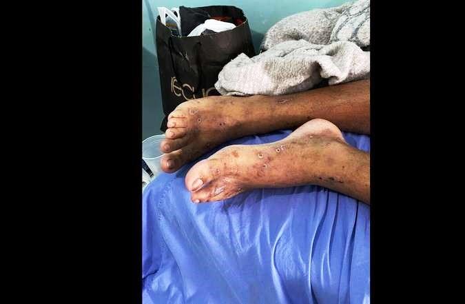 Detentos são ‘comidos vivos’ por bactéria desconhecida em Roraima