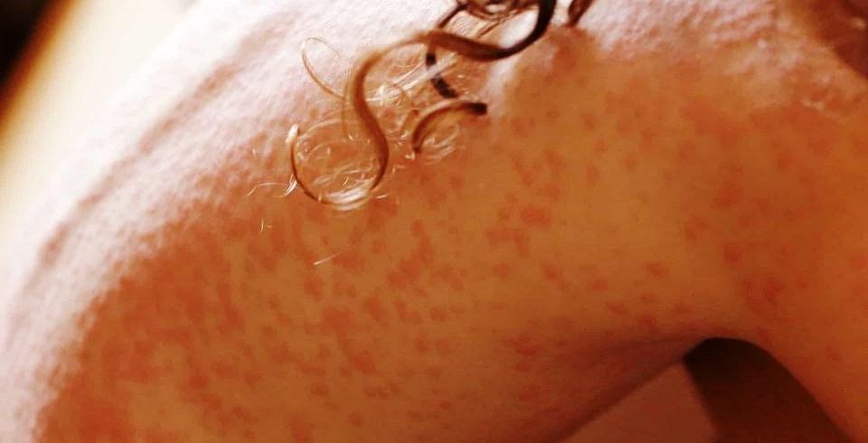 Sarna humana: doença contagiosa da pele causada por parasita