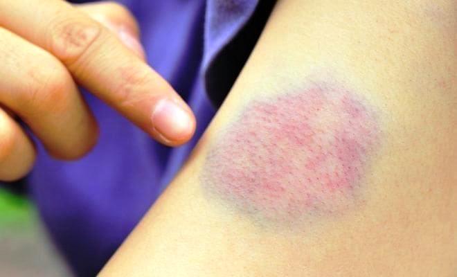 7 explicações para aquele roxo na pele que você não sabe de onde veio