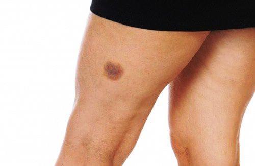 7 explicações para aquele roxo na pele que você não sabe de onde veio