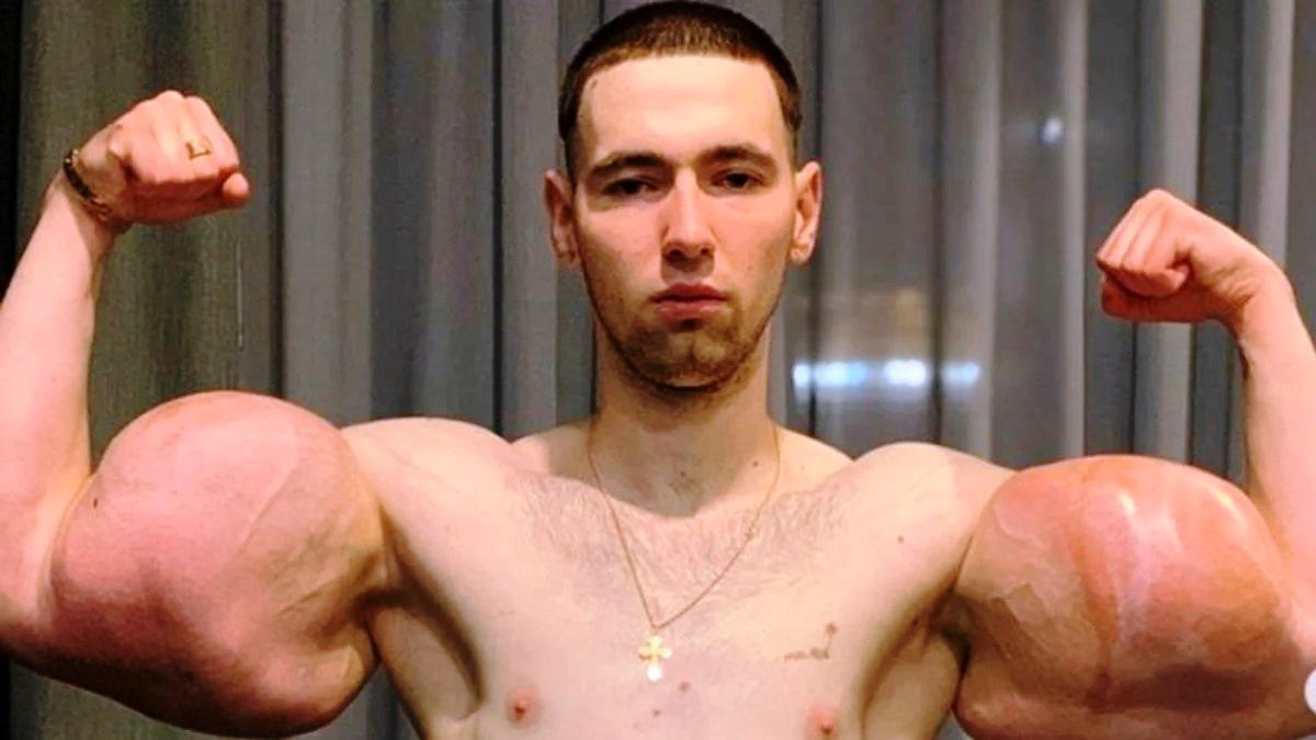 ‘Popeye humano’ pode perder movimentos dos braços após implantes