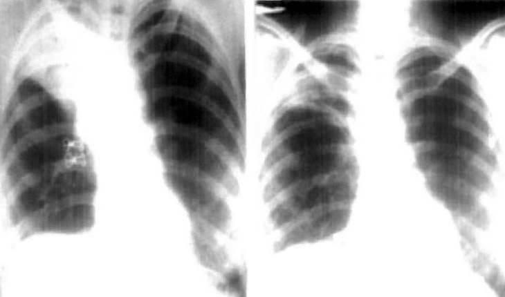 Professora com suspeita de tuberculose faz raio-X e médicos descobrem camisinha dentro dos pulmões