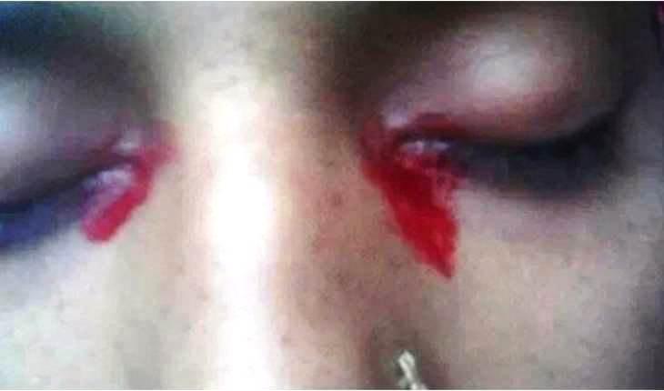 Mulher que ‘chora’ sangue intriga pessoas do mundo inteiro, mas possível causa é revelada