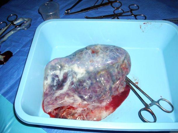 Comer placenta é uma prática natural ou é maluquice?