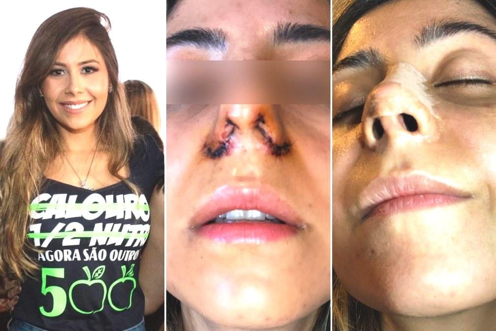 Pacientes relatam deformações em alectomia, após procedimento para afinar o nariz