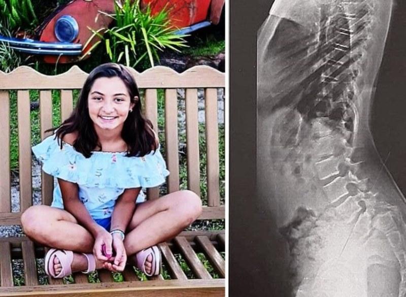 Menina com condição degenerativa precisa de “nova coluna”