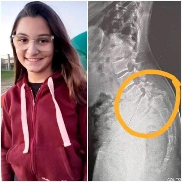 Menina com condição degenerativa precisa de “nova coluna”