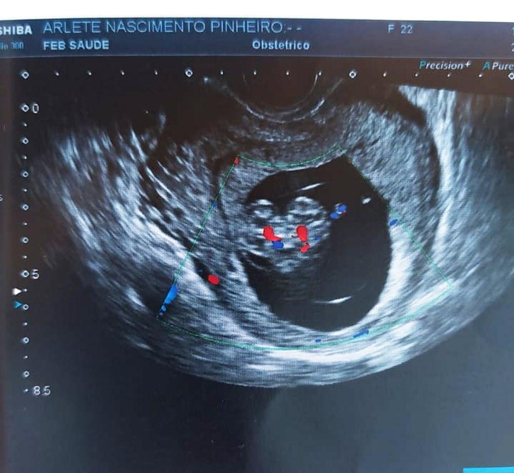 Grávida de gêmeos siameses que dividem o mesmo coração vive angústia por não saber se filhos vão sobreviver