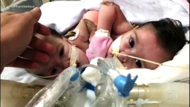 Grávida de gêmeos siameses que dividem o mesmo coração vive angústia por não saber se filhos vão sobreviver
