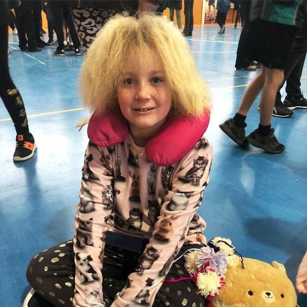 Síndrome do cabelo impenteável: mais sobre a anomalia que atinge 100 pessoas no mundo