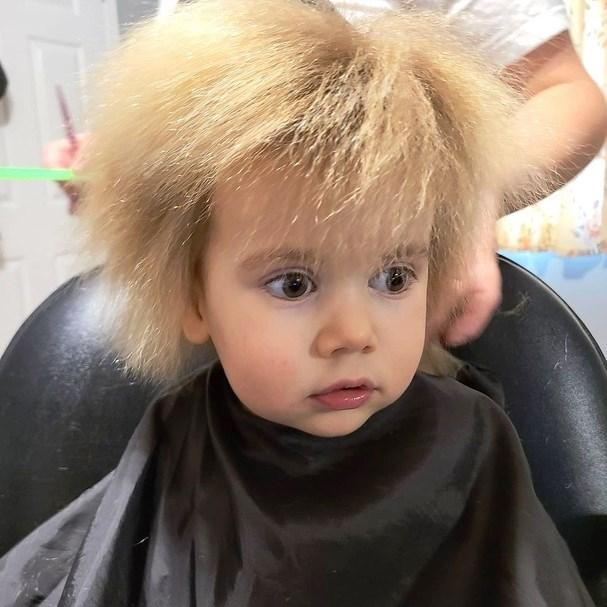 Síndrome do cabelo impenteável: mais sobre a anomalia que atinge 100 pessoas no mundo