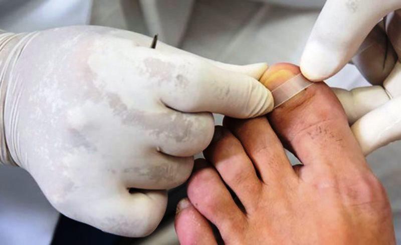 4 aparelhos incríveis usados para desencravar unhas