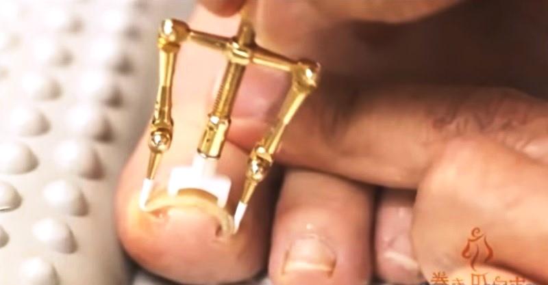 4 aparelhos incríveis usados para desencravar unhas