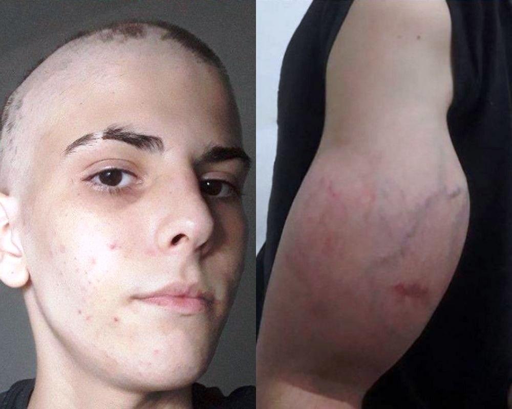 Adolescente descobre câncer e terá que amputar braço deformado