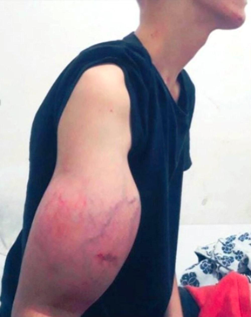 Adolescente descobre câncer e terá que amputar braço deformado