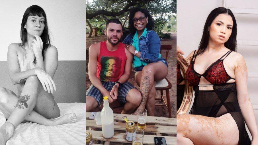 Vitiligo: “Ouvia das pessoas que era bonita, pena que tinha a pele manchada”
