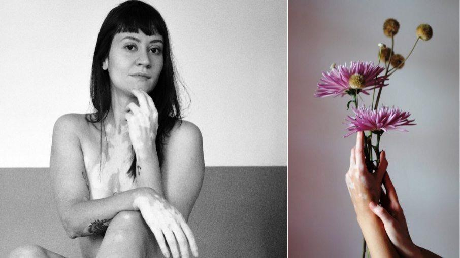 Vitiligo: “Ouvia das pessoas que era bonita, pena que tinha a pele manchada”