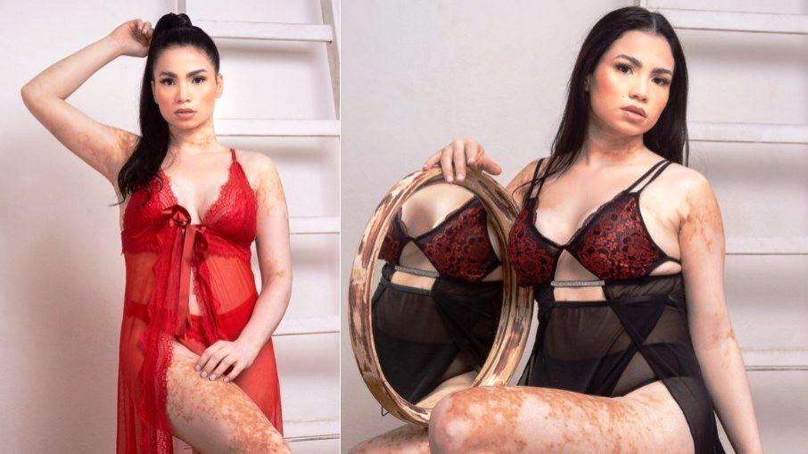 Vitiligo: “Ouvia das pessoas que era bonita, pena que tinha a pele manchada”
