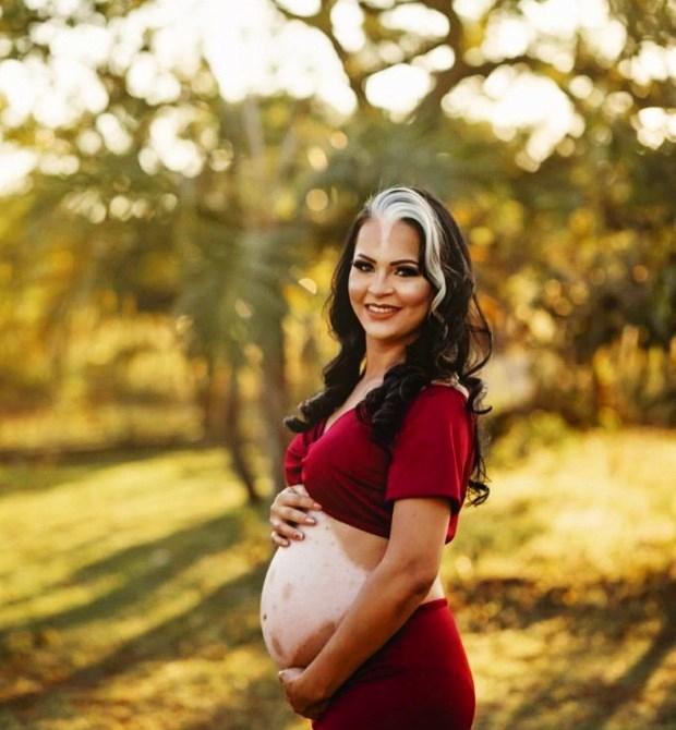 Mãe e bebê com condição rara fazem sucesso nas redes sociais: “Perguntam se pintamos os cabelos”