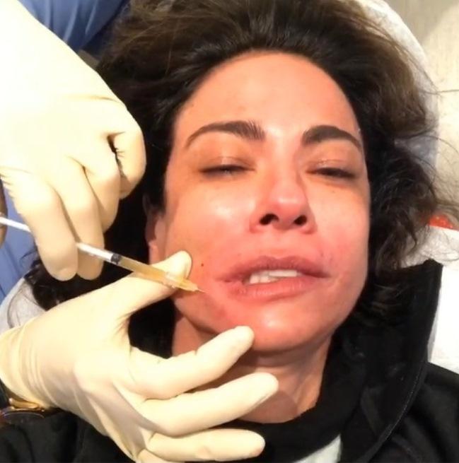 Vampire Facial: Conheça o procedimento que usa sangue para rejuvenescer a pele