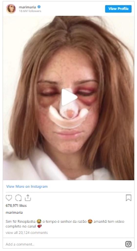 Rinoplastia: tudo o que você precisa saber sobre esse procedimento estético