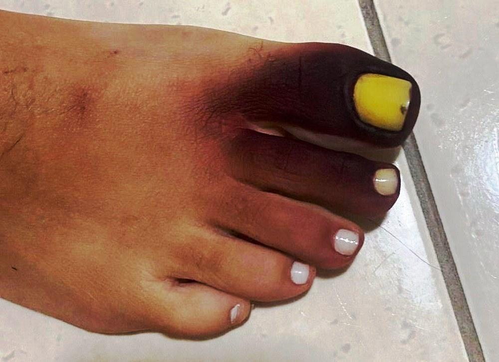 Mulher fica com pé roxo e unha amarela ao calçar tênis com piolho-de-cobra