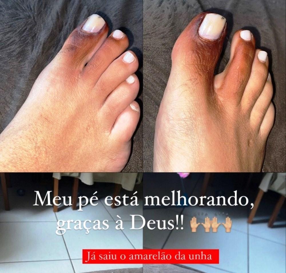 Mulher fica com pé roxo e unha amarela ao calçar tênis com piolho-de-cobra
