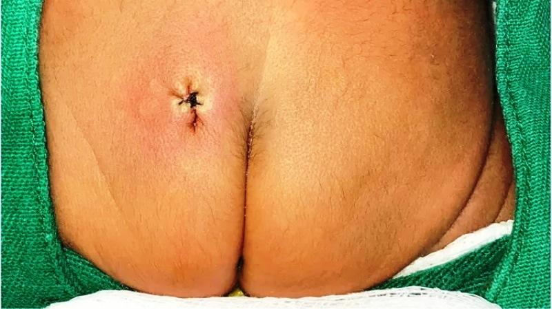 Bebê brasileiro nasce com cauda de 12 cm e bola de 4 cm na extremidade