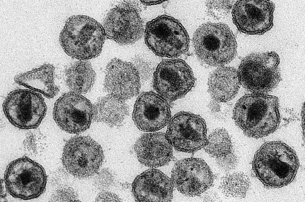 Anvisa aprova tratamento de HIV de apenas um comprimido