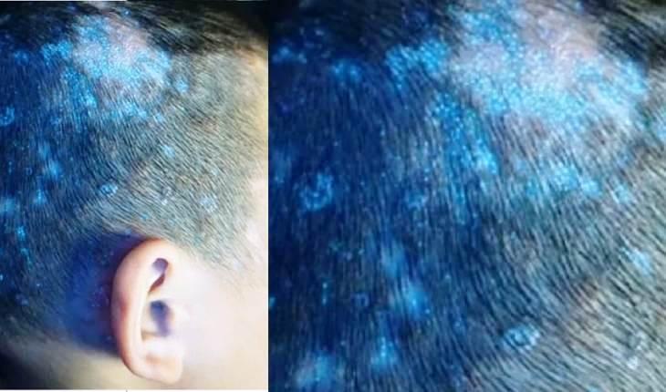 Criança fica com couro cabeludo brilhante após infecção fúngica
