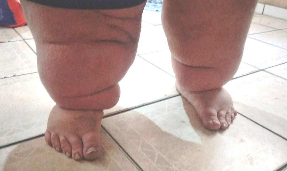 Jovem passa dos 300 kg e não consegue mais se pesar: ‘tenho muita fome’