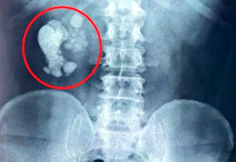 Homem passa por cirurgia e tem 156 cálculos renais retirados: ‘recorde’