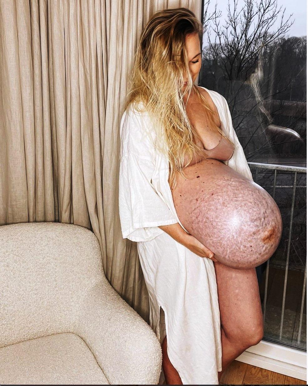 O que é a diástase abdominal, efeito de gravidez de múltiplos no corpo de blogueira da Dinamarca