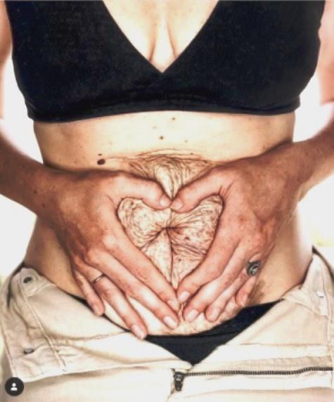 O que é a diástase abdominal, efeito de gravidez de múltiplos no corpo de blogueira da Dinamarca