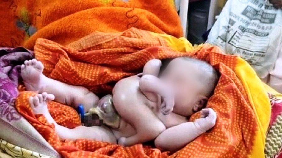 Bebê com quatro braços e quatro pernas é tratado como Deus na Índia