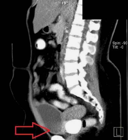 Médicos descobrem pedras ‘gigantes’ na vacina de paciente