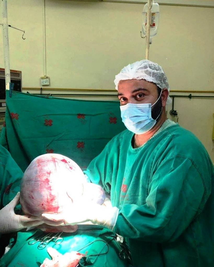 Idosa retira cisto gigante de 10 kg no norte do Rio
