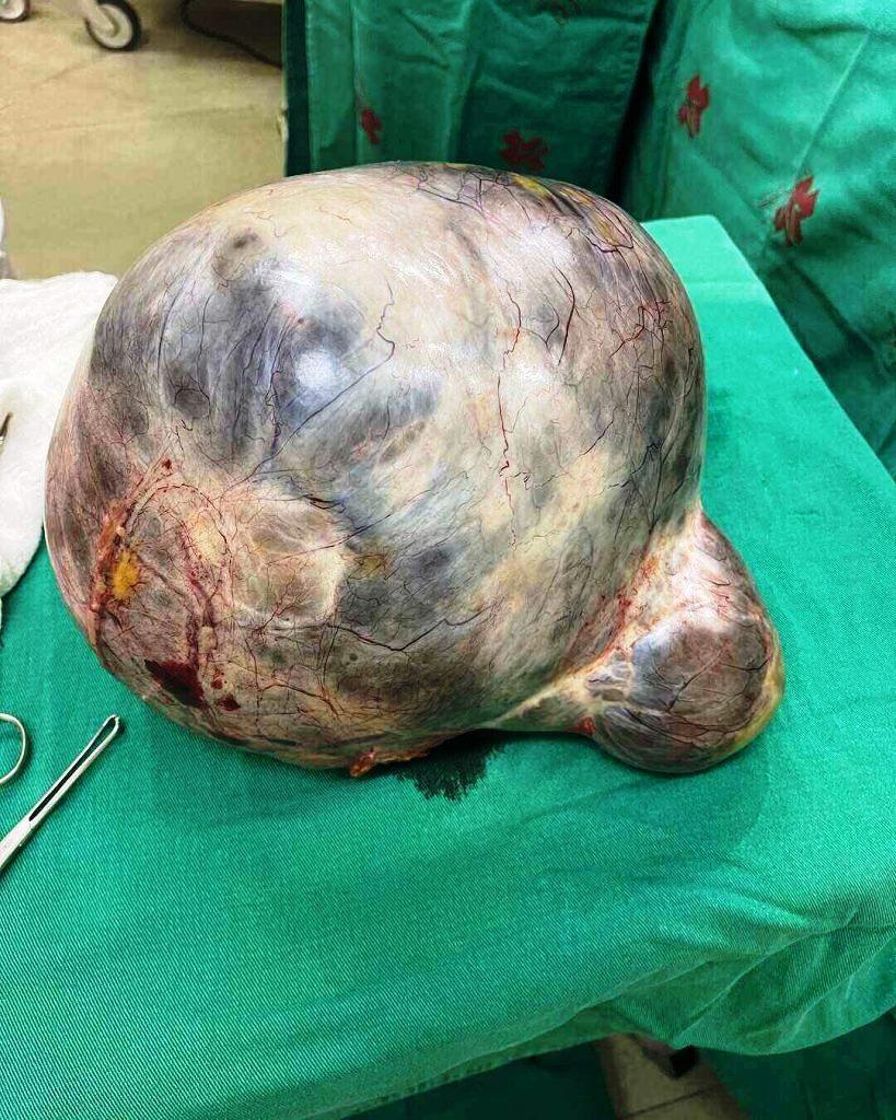 Idosa retira cisto gigante de 10 kg no norte do Rio