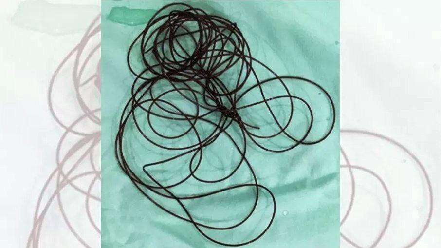 Homem passa por cirurgia ao inserir cabo de nylon de 2 metros no pênis