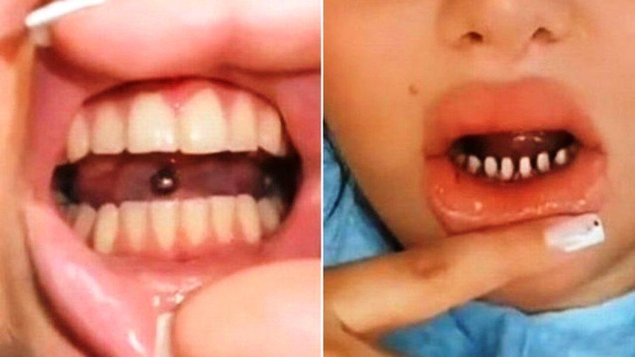 ‘Assassinato de dentes’ por ‘sorriso perfeito’, diz dentista