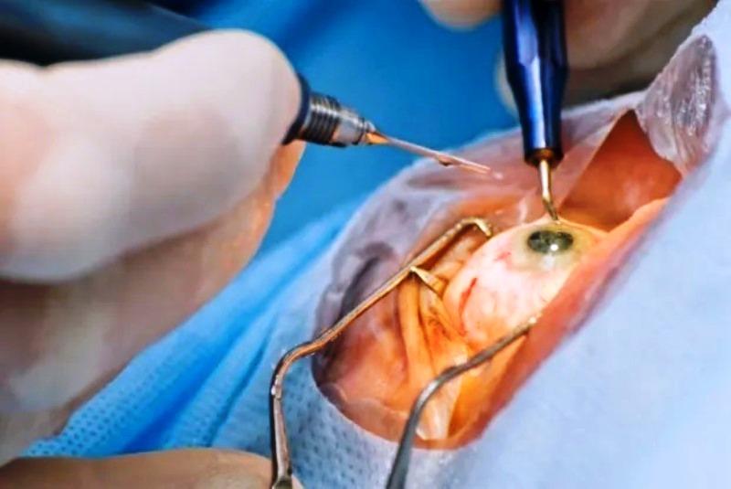 Conselho Brasileiro de Oftalmologia alerta para importância de cuidados em mutirões oftálmicos