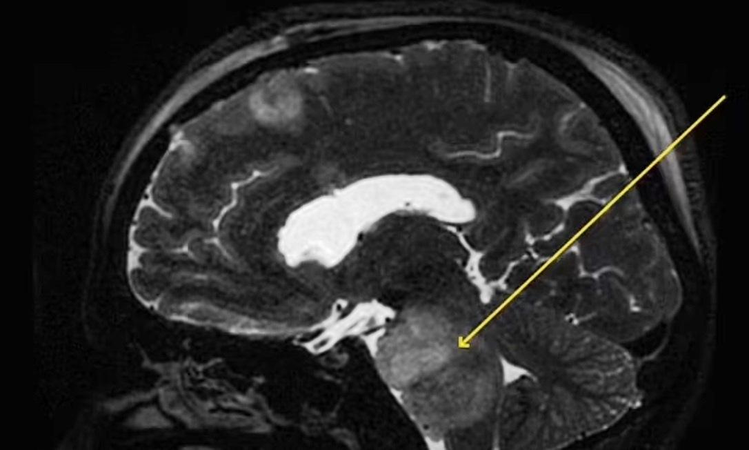 Crise de soluço de quatro meses em indiano pode ter sido causada por tumor no cérebro