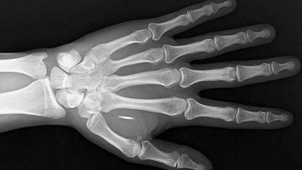 Microchips implantado sob a pele da mão permite pagamento com a mão