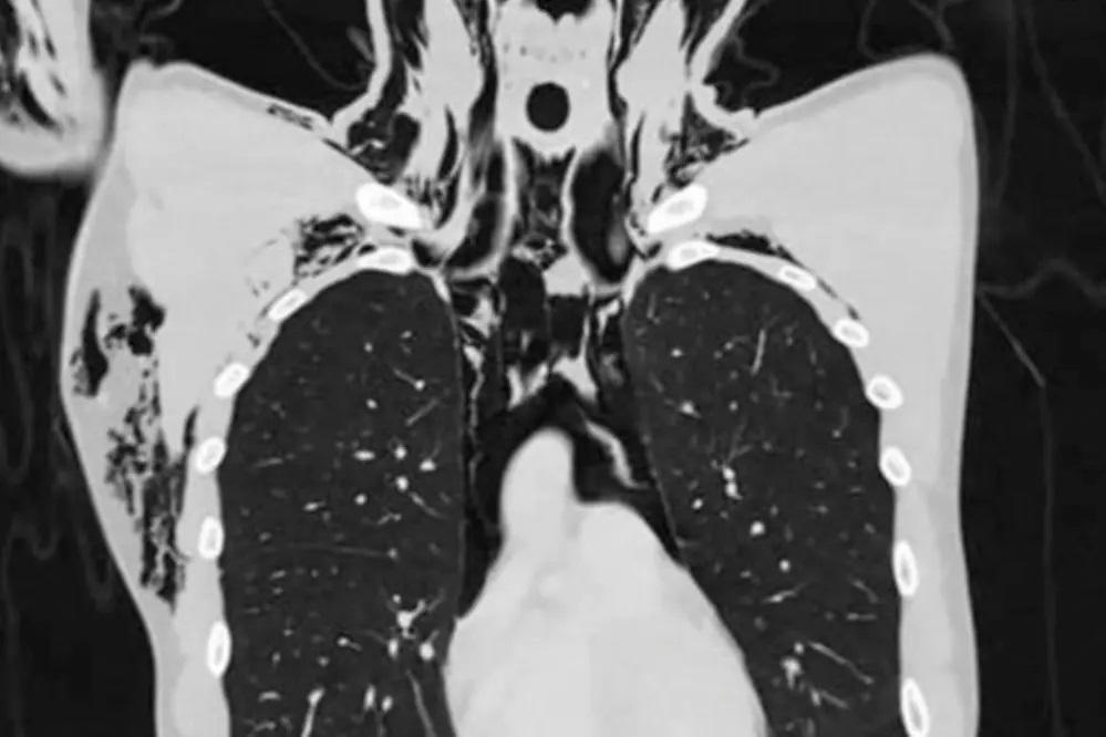 Após se masturbar jovem é internado na UTI com condição pulmonar rara