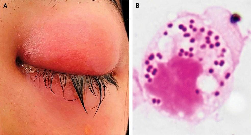 Infecção sexualmente transmissível pode afetar os olhos; saiba como se proteger