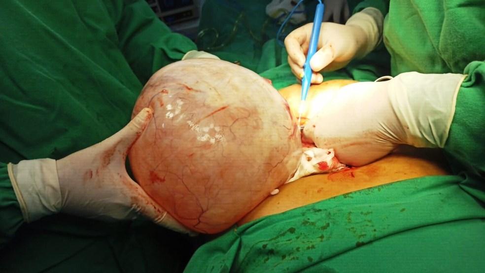Médicos retiram cisto de 5 kg do ovário de idosa durante cirurgia de emergência