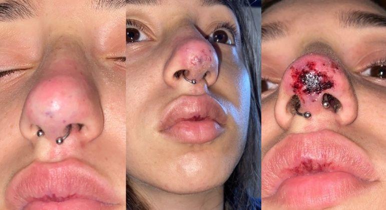 Jovem fica com o nariz necrosado após procedimento estético malsucedido