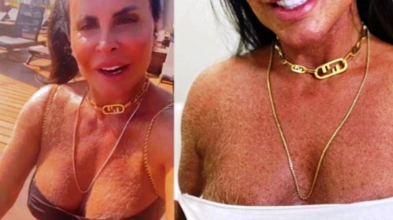 Médico explica possíveis causas de peito e braços peludos de Gretchen
